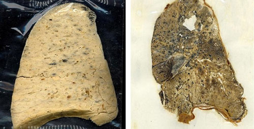 ConsecuenciasFig2 “Una sección de un pulmón normal liofilizado (izquierda) y una sección de un pulmón silicótico liofilizado (derecha). La sección del pulmón sano es de color amarillento claro y la del pulmón silicótico es de un color marrón más oscuro”.