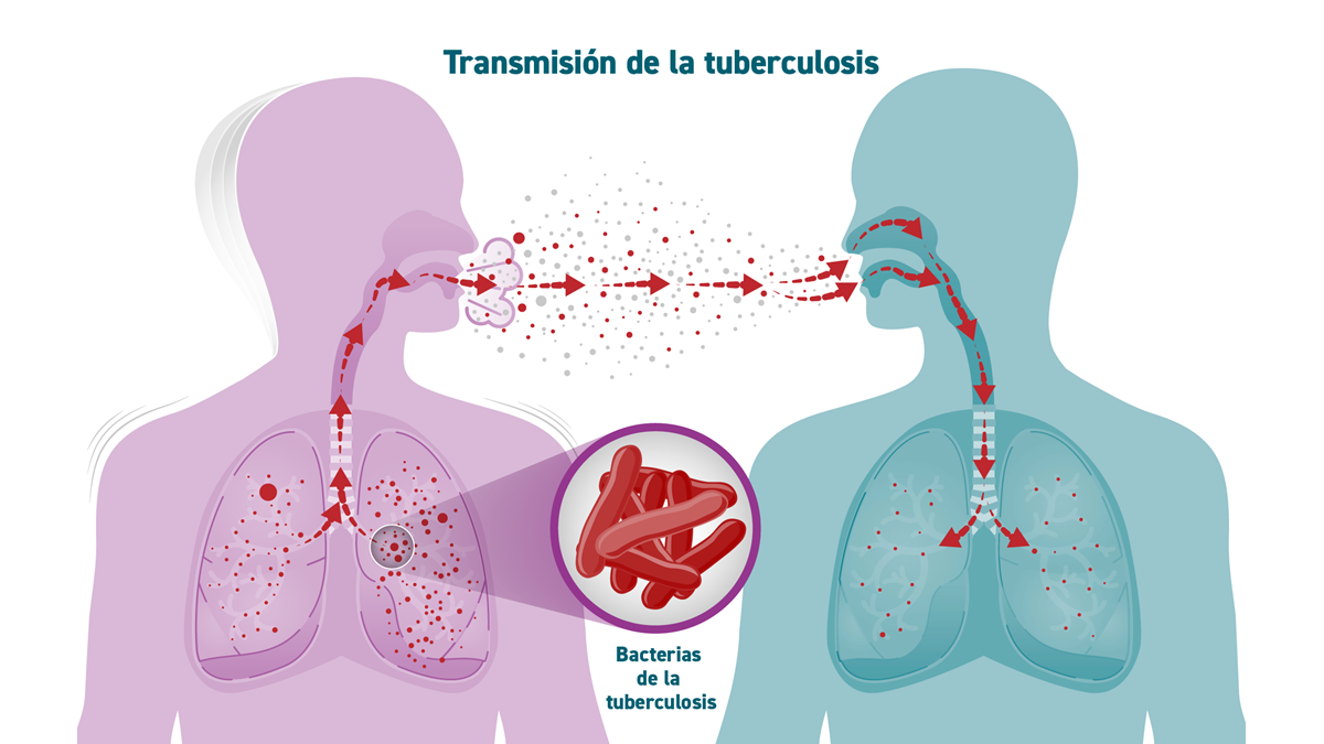 Un gráfico muestra los microbios de la tuberculosis propagándose de una persona a otra