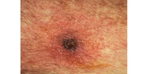 Eschar at site of a chigger bite.