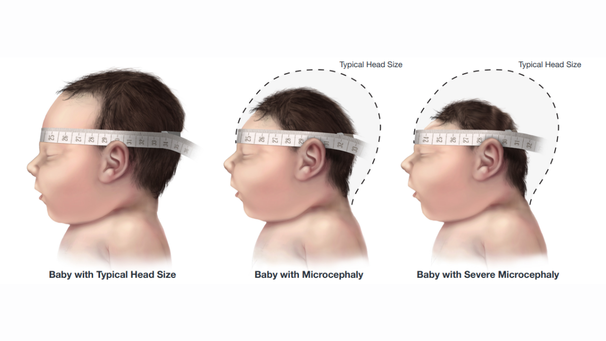 — title missing — A baby with a typical size head, a baby with microcephaly, and a baby with severe microcephaly